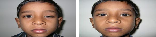 Eyelid Drooping (Ptosis)